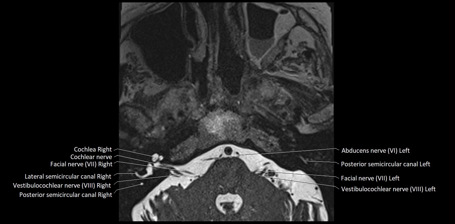 Cranial nerve anatomy axial MRI 3T image 58.webp